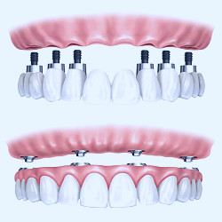 Full Mouth Dental Implants Cost in Palos Verdes and South Bay, California